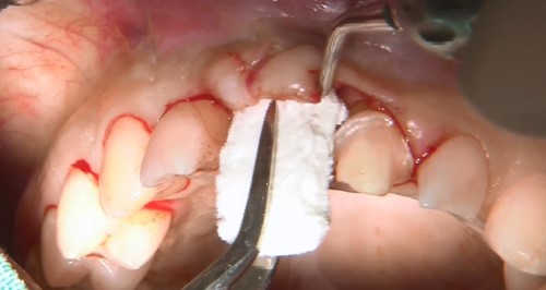  How to use the available soft tissue substitutes